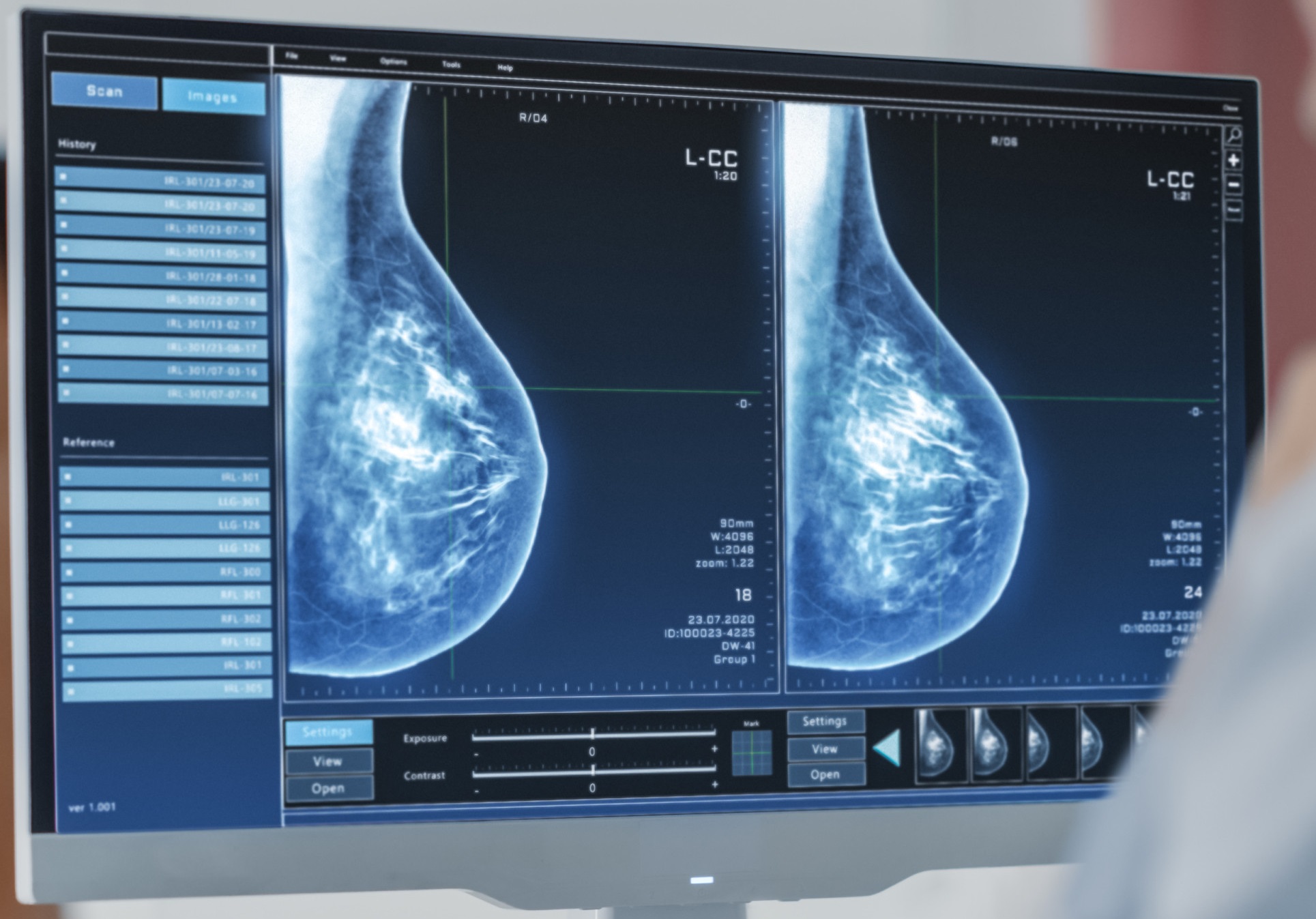 Breast imaging study displayed on a mammography workstation